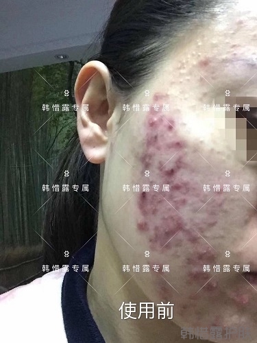 膿包痘痘好了，從慘不忍睹到變美變漂亮