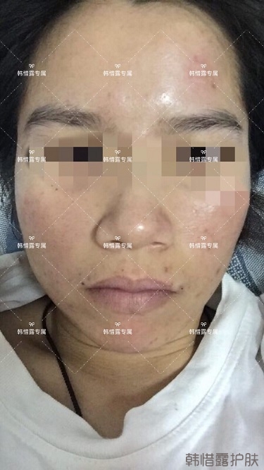 膿包痘祛痘效果，擁有干凈的臉不等待！