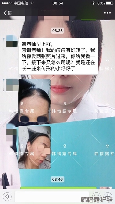 多年的粉刺痘痘，沒(méi)想到使用一周后粉刺消了這么多！