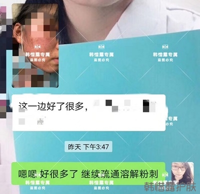 臉上長(zhǎng)閉口粉刺怎么去除,粉刺消下去了，皮膚變好了