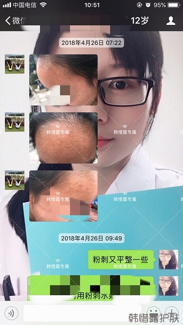 粉刺怎么辦？粉刺去除反饋：不要被粉刺遮住光潔的額頭