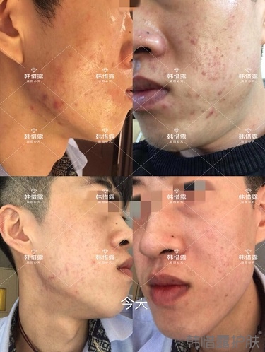 敏感肌粉刺痘痘全部消下去了，痘坑也修復平整了一部分