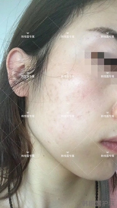 痘痘好了皮膚美麗，不想再記起曾經滿臉痘痘的自己！