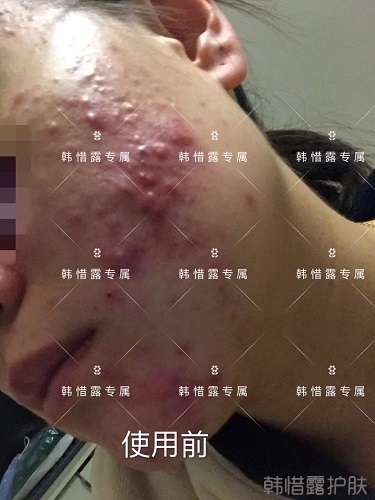 膿包痘痘好了，從慘不忍睹到變美變漂亮
