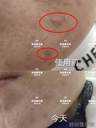 怎么消除臉上的痘痘，發(fā)硬膿包消下去了