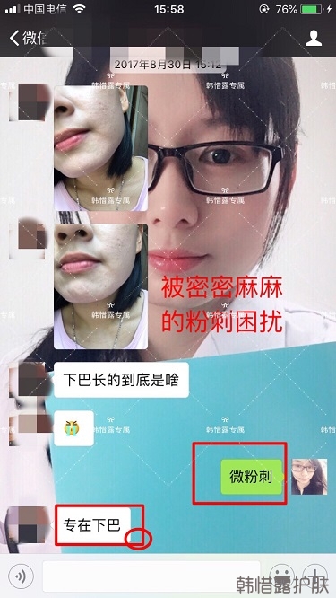 粉刺密密麻麻，試過很多方法無果后找韓惜露老師輕松去掉粉刺！