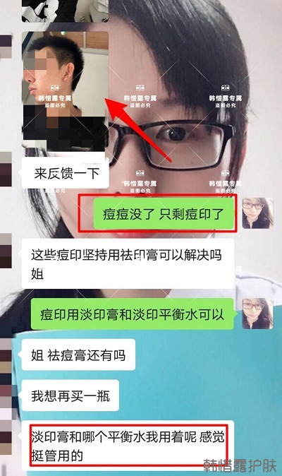 痘印怎么去？痘印調(diào)理案例，痘印淡化了