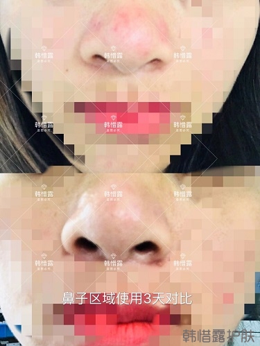 鼻子發(fā)紅長痘痘消了，皮膚吸收好就是任性！