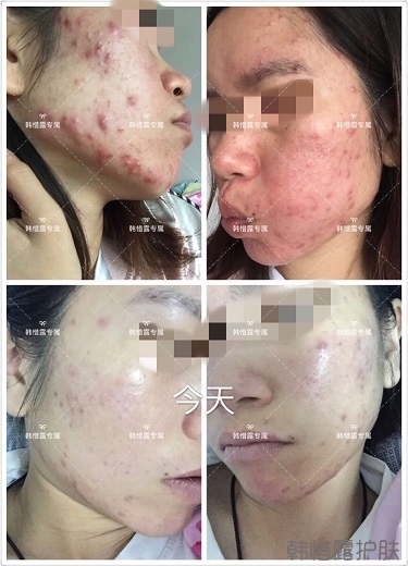 膿包痘祛痘效果，擁有干凈的臉不等待！