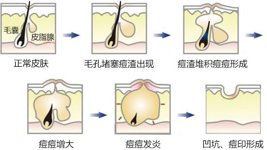 有去痘印最有效的方法嗎？
