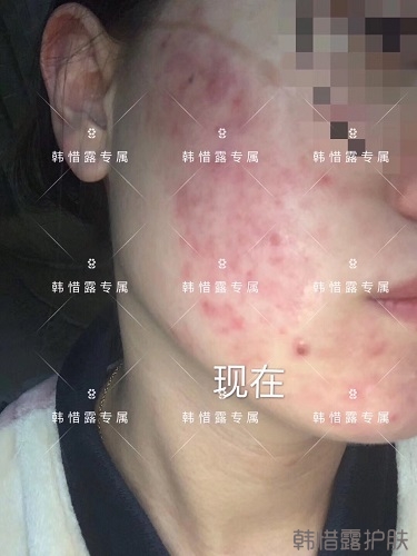 膿包痘痘好了，從慘不忍睹到變美變漂亮