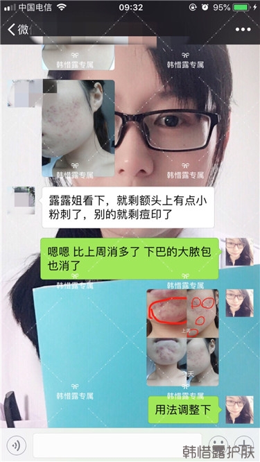 粉刺只剩一點點了，敏感肌粉刺修復，更美麗！