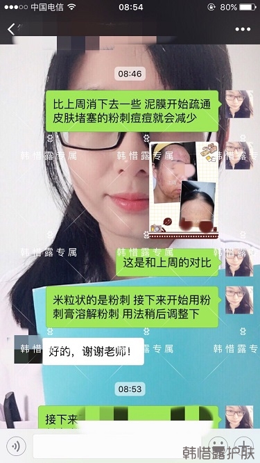 多年的粉刺痘痘，沒(méi)想到使用一周后粉刺消了這么多！