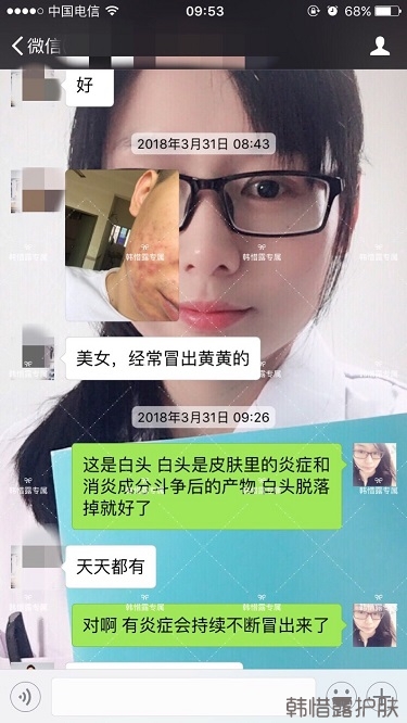膿包結(jié)節(jié)發(fā)硬痘痘全消了，帥哥開心的來(lái)反饋了！
