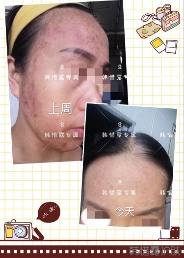 多年的粉刺痘痘，沒(méi)想到使用一周后粉刺消了這么多！