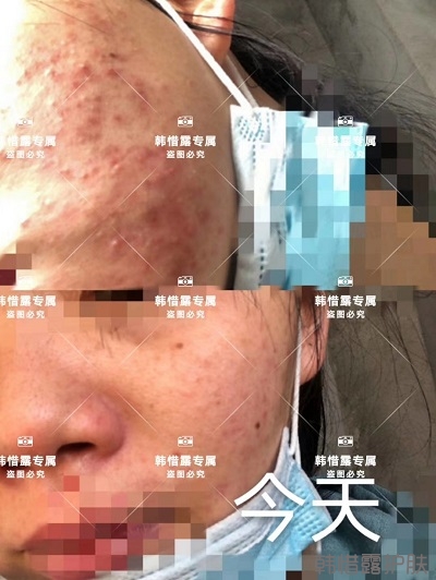 臉上長(zhǎng)閉口粉刺怎么去除,粉刺消下去了，皮膚變好了