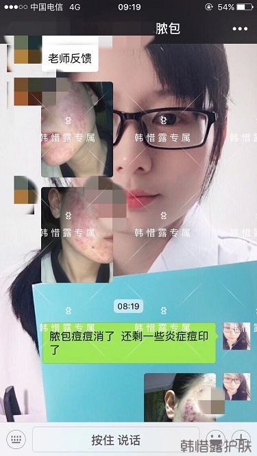 膿包痘痘好了，從慘不忍睹到變美變漂亮