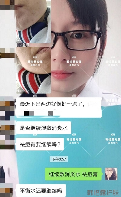 怎么消除臉上的痘痘，發(fā)硬膿包消下去了