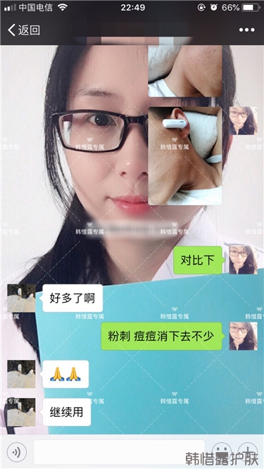 粉刺消了，皮膚光滑了，變帥氣不少呦！