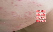 臉上長粉刺去粉刺的方法!不可錯(cuò)過的去痘痘粉刺變美機(jī)會(huì)！