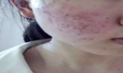 痘花妹變無暇美女