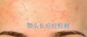 額頭長痘，臉頰長痘痘粉刺，就這樣恢復(fù)嫩白肌膚！