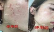 痘痘好了皮膚美麗，不想再記起曾經滿臉痘痘的自己！