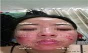 【祛痘視頻反饋】激素臉長痘20多年，大膿包，發(fā)癢，完全恢復(fù)！