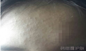 臉上長粉刺了能用祛痘精華嗎？有效果嗎？