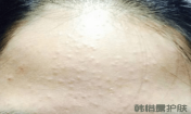 如何去除額頭的粉刺？