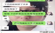 閉口粉刺怎么去除，下巴粉刺好了許多，粉刺沒有再長了