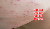 臉上長粉刺去粉刺的方法!不可錯過的去痘痘粉刺變美機會！