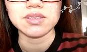 【祛痘視頻反饋】經期容易長痘，讓人很絕望，現在已經沒有痘痘了。